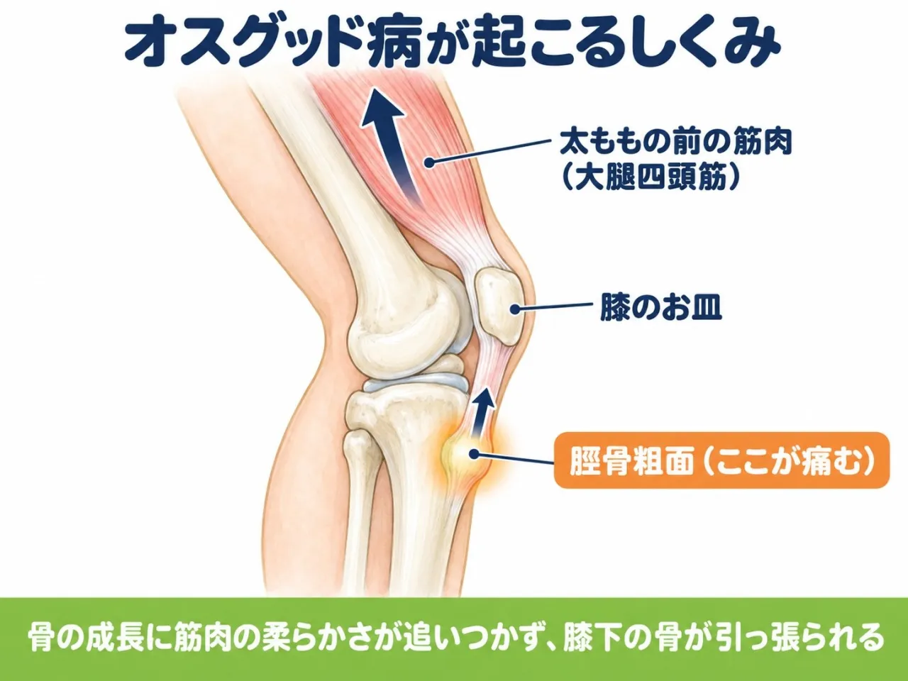 オスグッド病が起こるしくみ｜大腿四頭筋が脛骨粗面を引っ張る図解